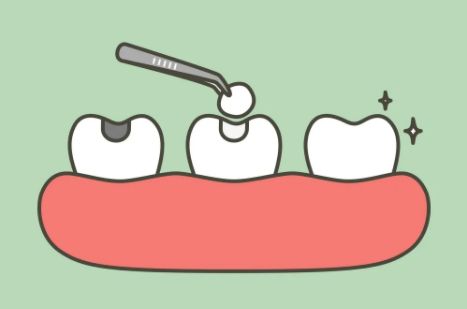 北上補牙是否真系平很多？