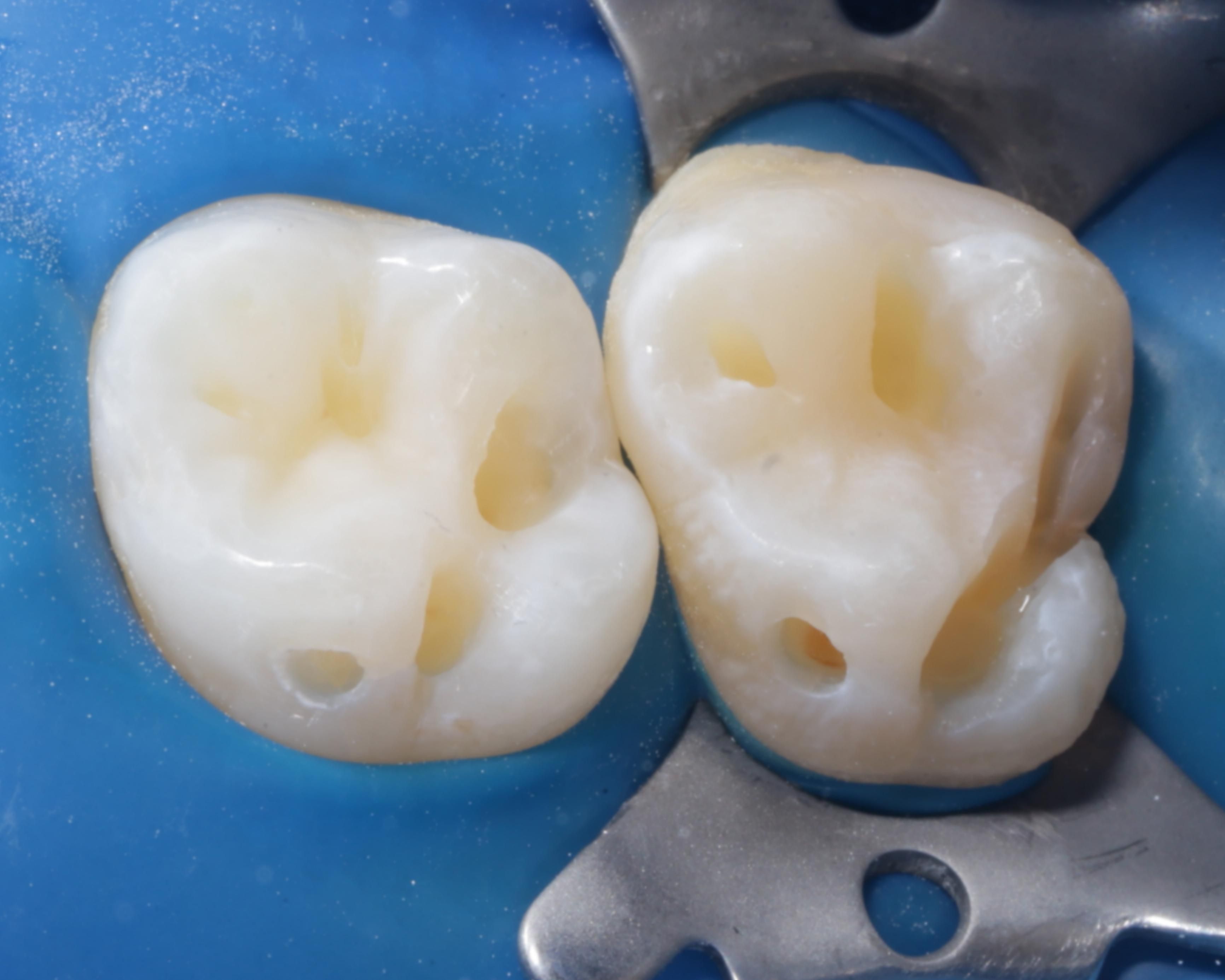 北上補牙適唔適合敏感牙齒患者？