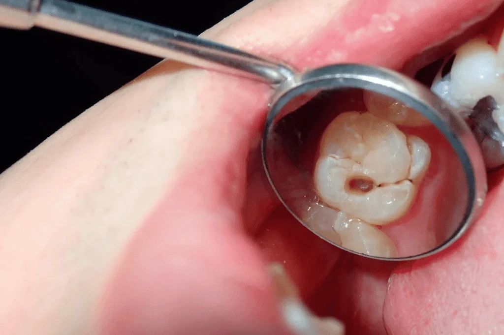 北上補牙是否適合家庭治療？