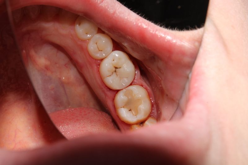 北上補牙適唔適合需要急救嘅情況？