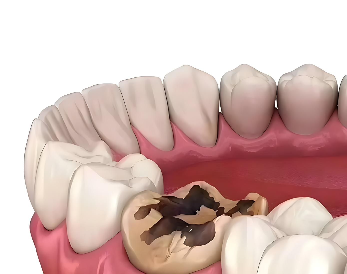 北上補牙成功率高唔高？