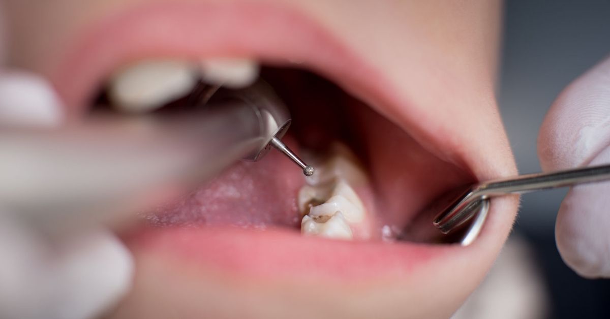 北上補牙治療是否好快?