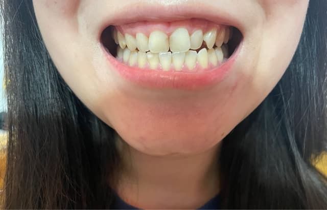 北上補牙適唔適合每個年齡層?