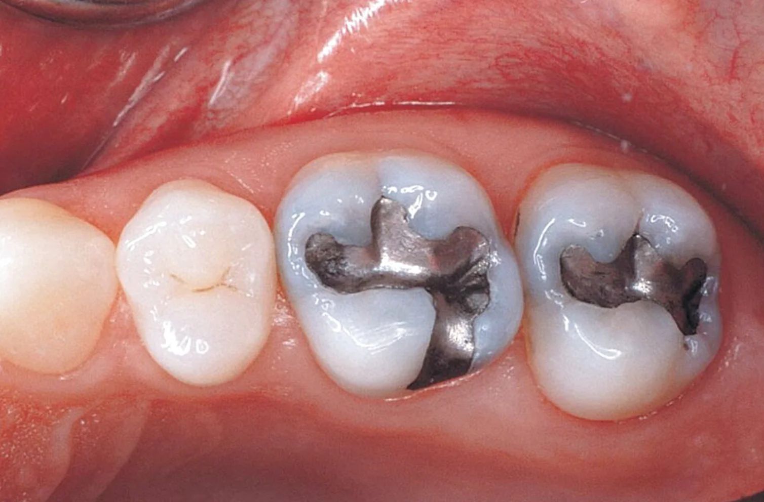 北上補牙會唔會影響牙根?