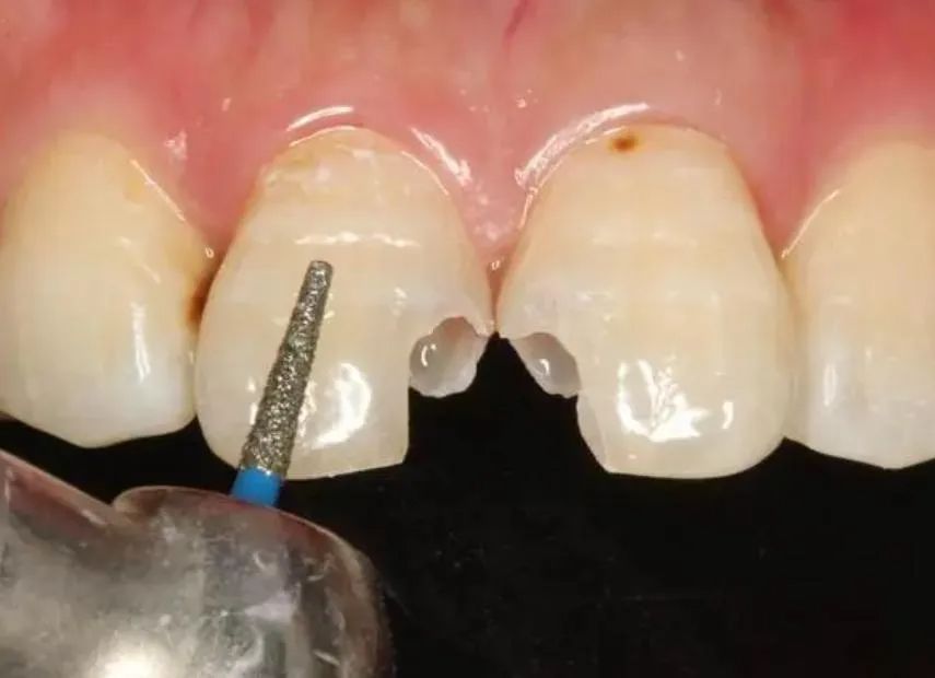 北上補牙治療期間要點安排工作？