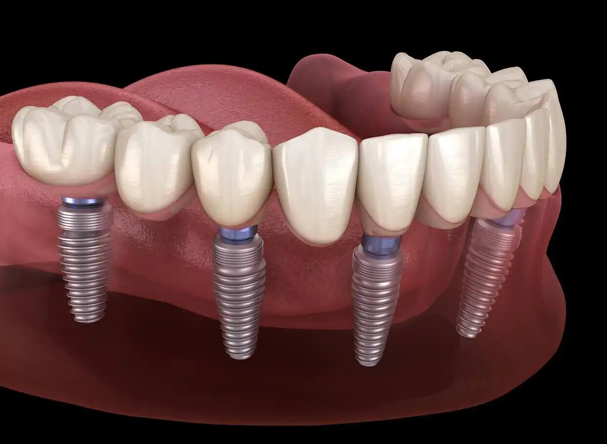Do I need a comprehensive oral examination for a single dental implant in Beijing