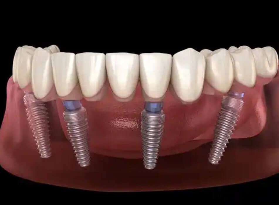 北上種植牙診所有冇幫忙過關指引?