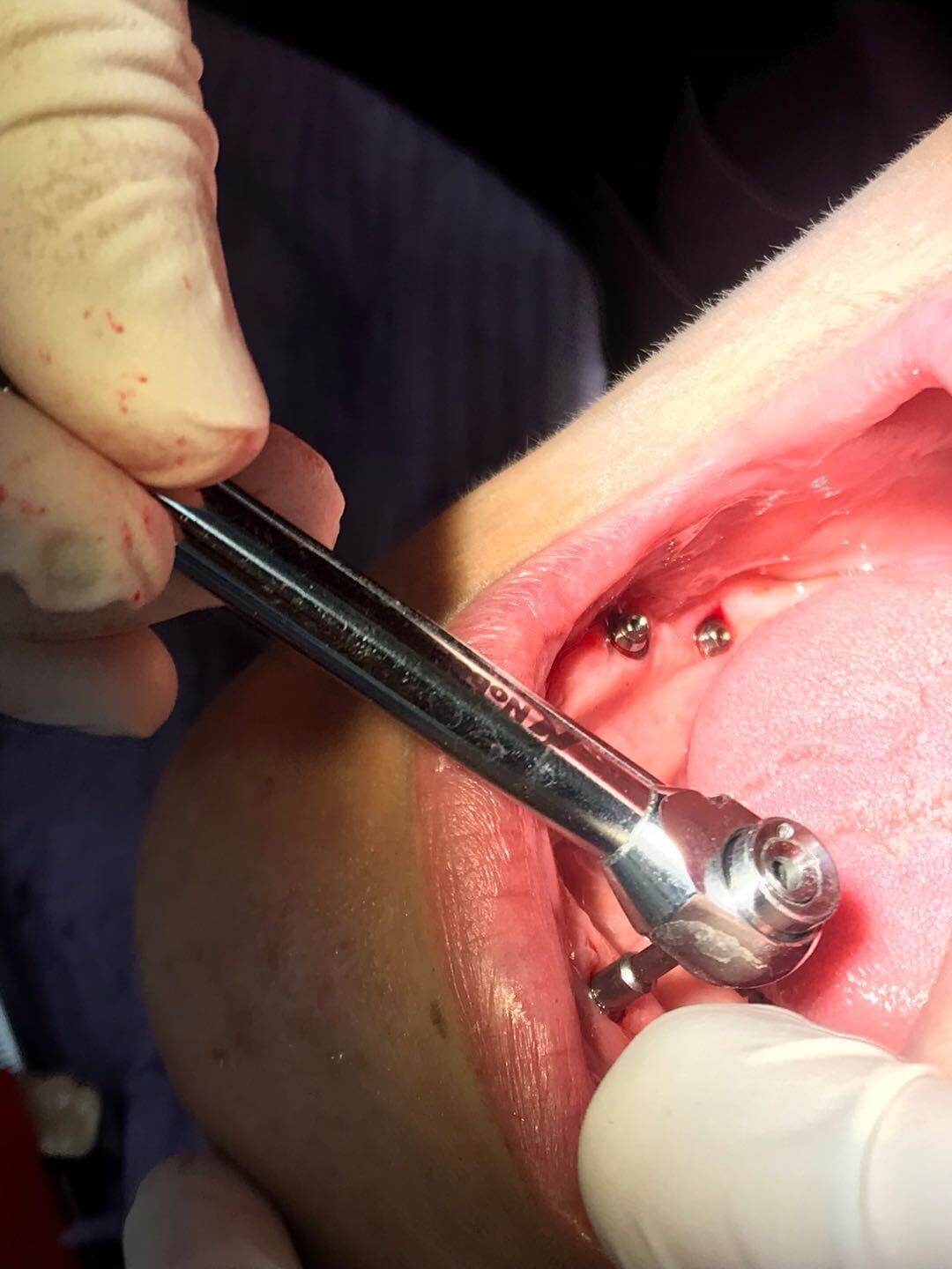 北上種植牙診所有冇術後跟進?