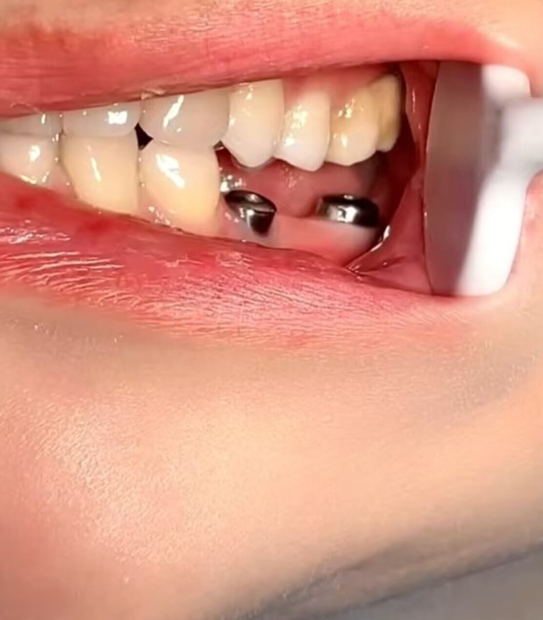 北上種植牙做一次要幾耐?