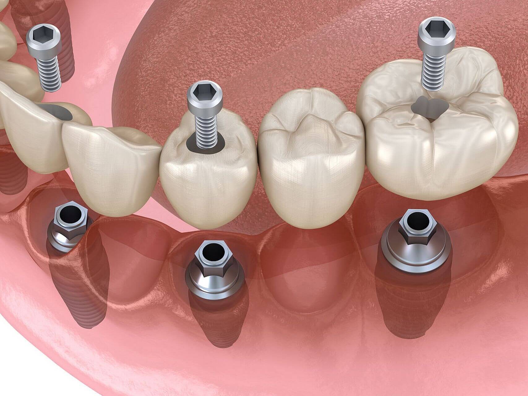 北上種牙係咪可以當天完成初診?