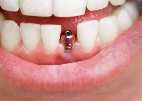 北上種牙價錢會唔會比香港平好多?