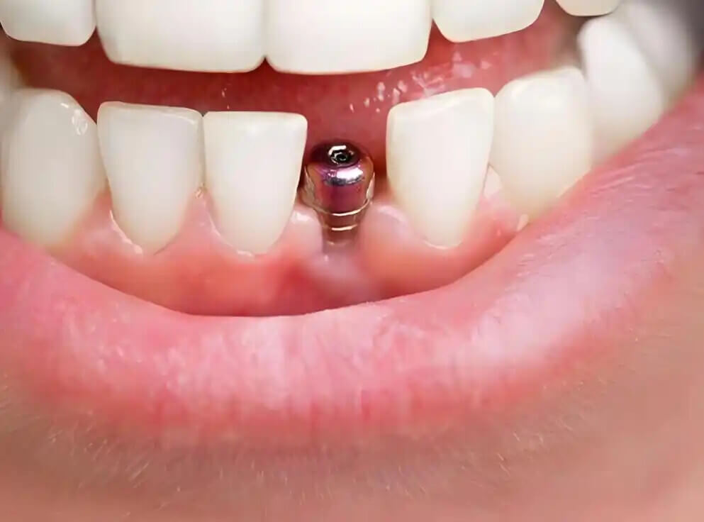 北上種牙價錢包唔包術後復查?