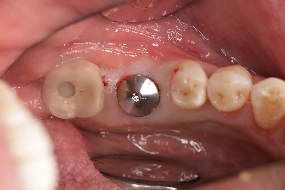 北上種牙係咪可以帶屋企人陪同?