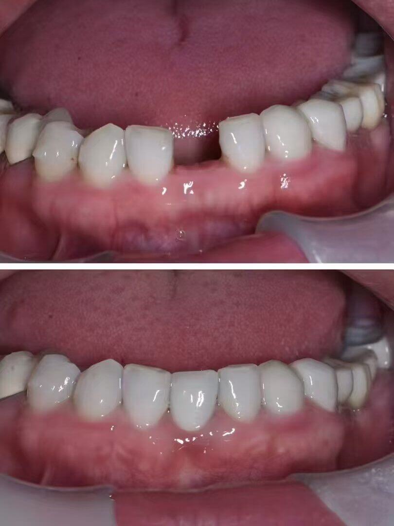 北上種植牙價錢點分國產同進口?