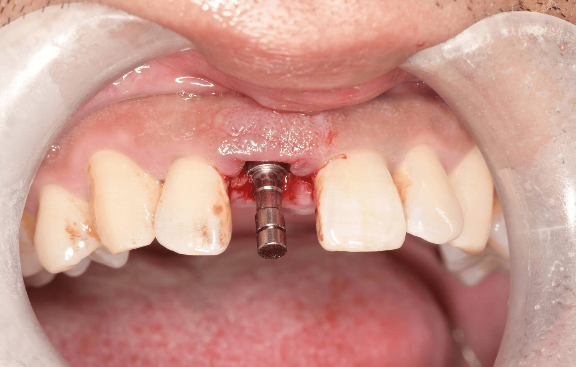 北上種牙前要唔要驗血?