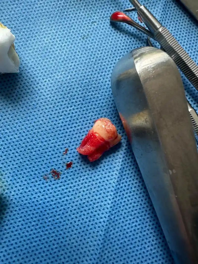 北上拔智齒術後幾耐可以開口大?