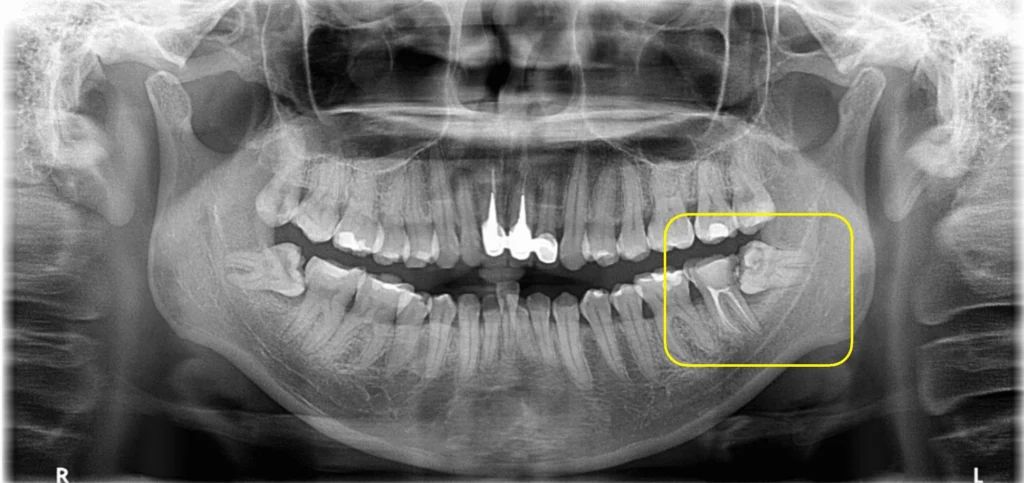 北上拔智齒要唔要麻醉？