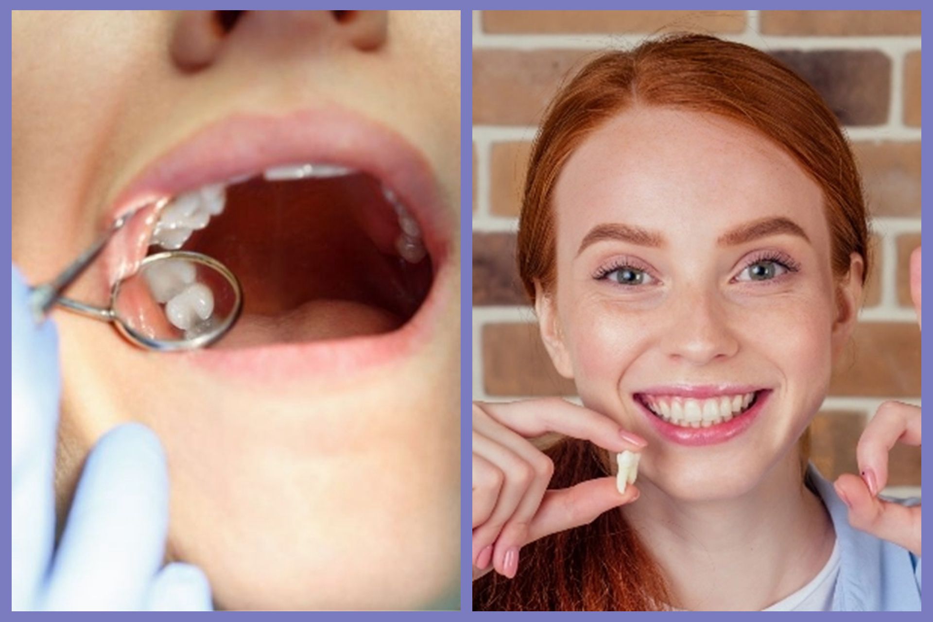 北上拔智齒術後會唔會腫？