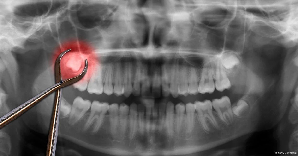 北上拔牙感覺舒適嗎？