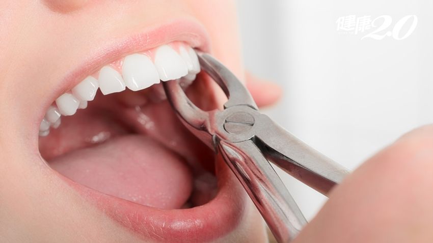 北上拔牙術後幾日消腫？