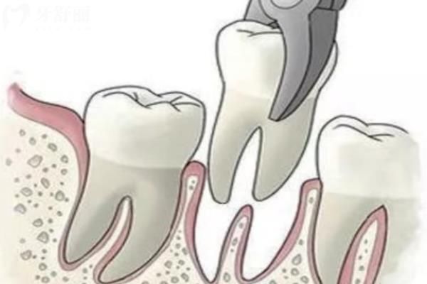 北上拔牙術後腫脹正常嗎？