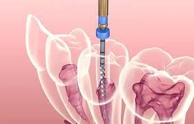 After undergoing root canal treatment in the Northern District, is medication necessary