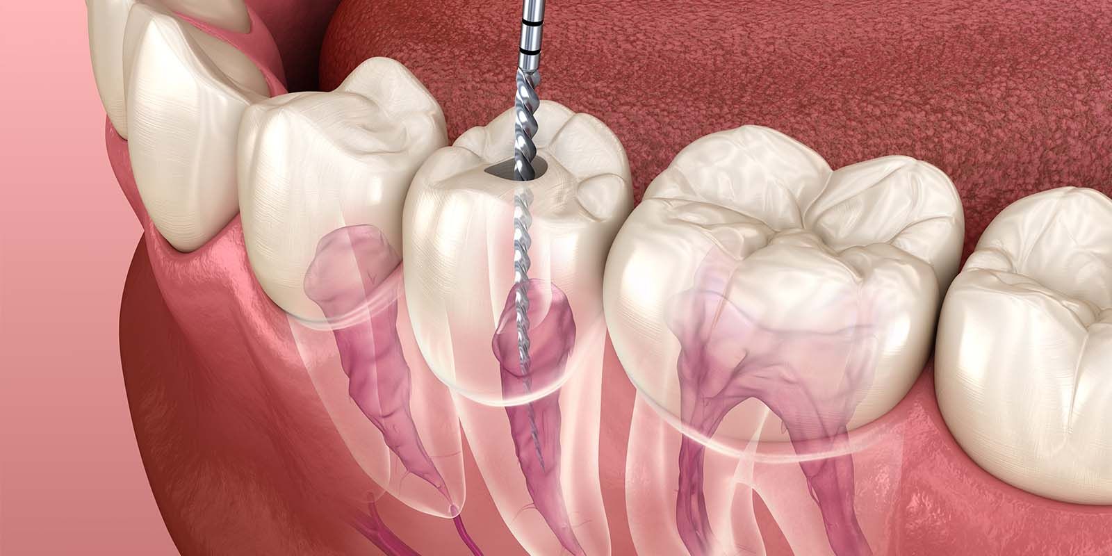 After undergoing root canal treatment, will there be any soreness or pain