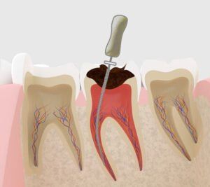 Is a loose gum after getting dental implants in the north indicative of incomplete integration