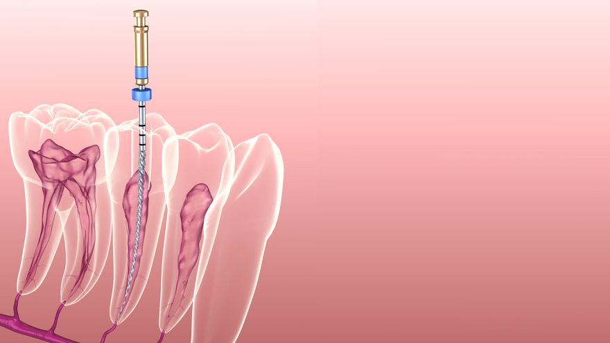 Can a Root Canal Treatment Be Completed in One Visit in The North