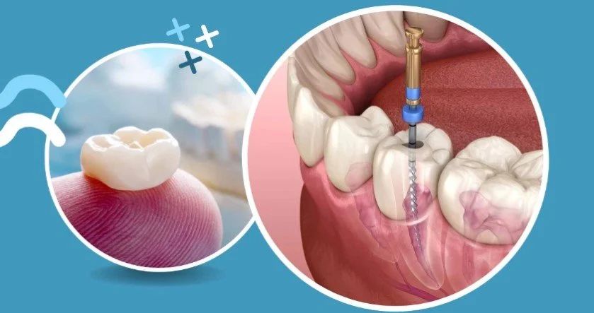 Is a Follow-up Appointment Necessary After Root Canal Treatment in the Northern Region