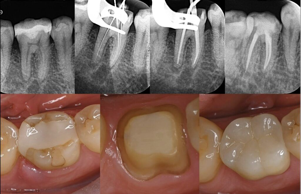 Will Teeth Become Loose After Root Canal Treatment