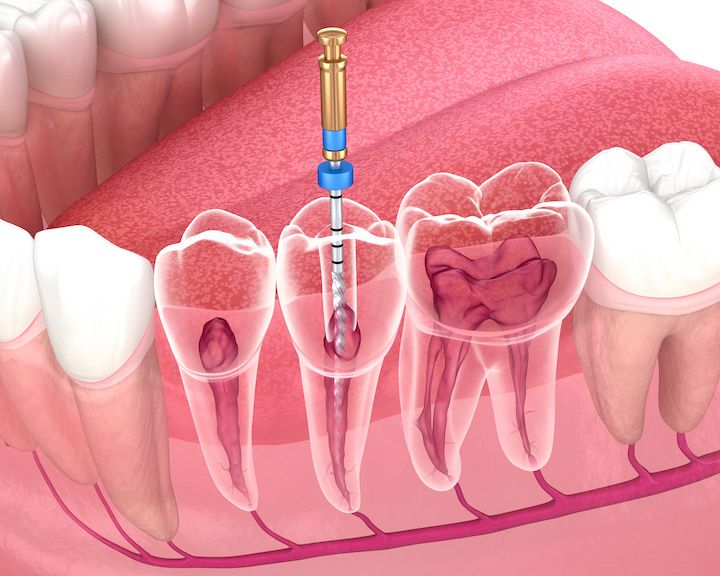 Are Northbound Root Canal Treatment Doctors Patient in Their Explanations