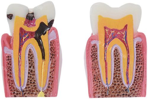 After Undergoing Root Canal Treatment in Beijing Key Considerations and Care Instructions
