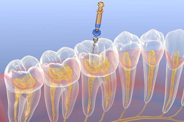 Will sneezing be painful after getting dental implants up north because the jawbone is not stabilized