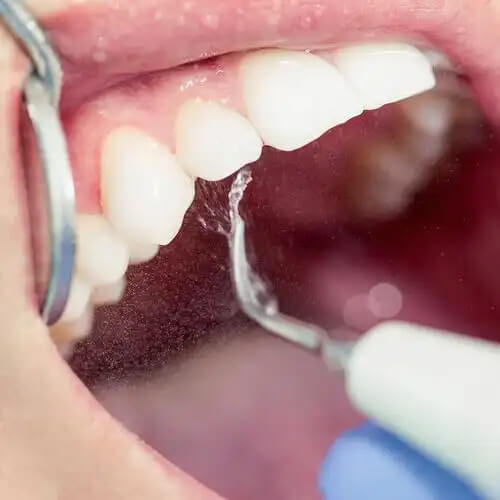 Teeth Cleaning in Mainland China vs Hong Kong Whats the Price Difference