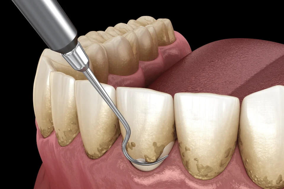 A First-Hand Review of Dental Cleaning in Mainland China Fast, Thorough, and Painless