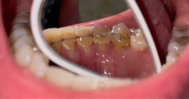 Is it really much cheaper to go to Mainland China for a dental cleaning