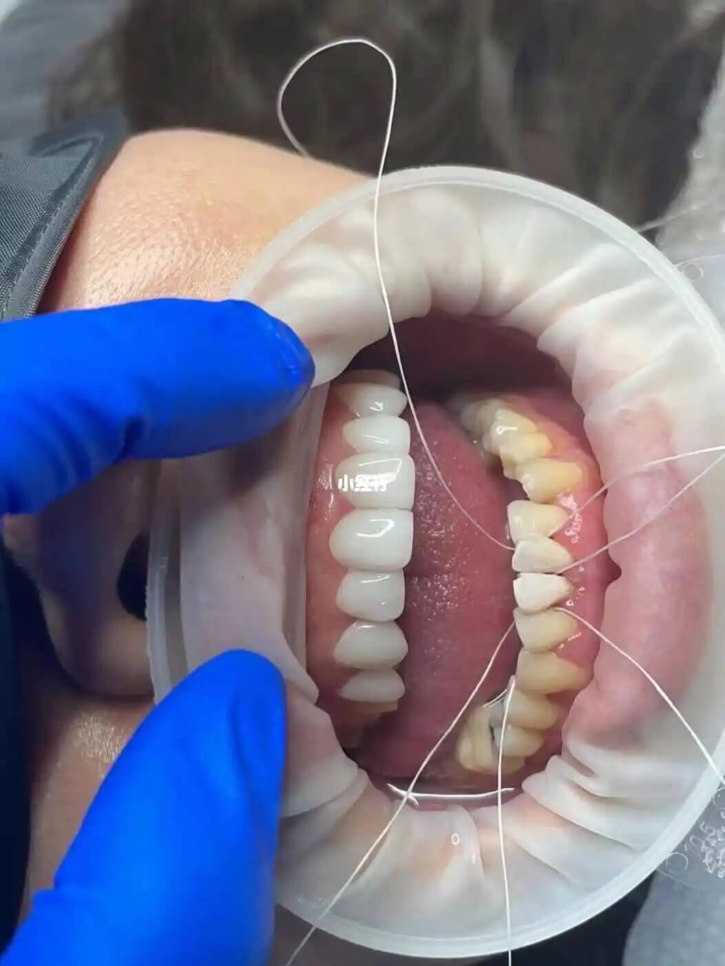 Ultimate Guide to Teeth Cleaning in Mainland China Procedure and Costs at a Glance