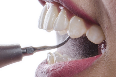 Mainland teeth-cleaning prices revealed—unbelievably cheap