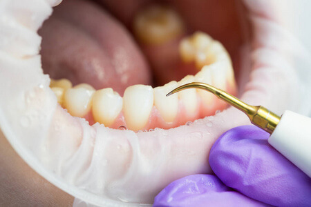 Teeth Cleaning in Mainland China What Services Are Available Ultrasonic Scaling and Air Polishing Explained