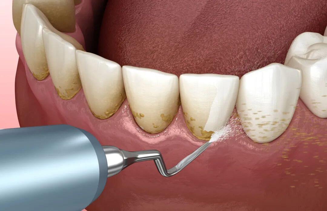 What’s the difference between teeth cleaning (scaling) and teeth whitening in Mainland China