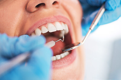 Fast-Track Dental Scaling Get Your Teeth Cleaned Quickly When Heading North