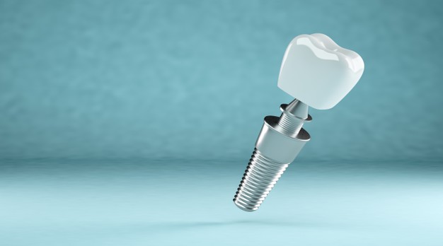 親身經歷告訴你：嵌體修復的牙齒可以用多久-