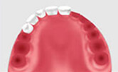 種植牙手術注意要點及種植牙並發症