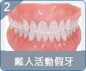 澳門allon4種植牙推薦