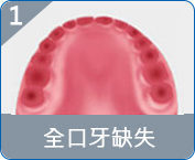澳門allon4種植牙推薦