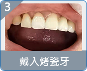拱北全口重建邊度好