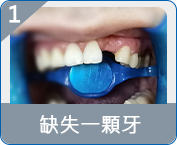 拱北全口重建邊度好