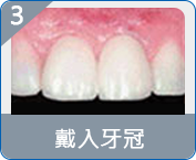 氹仔半口假牙費用