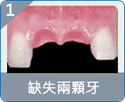 氹仔半口假牙費用